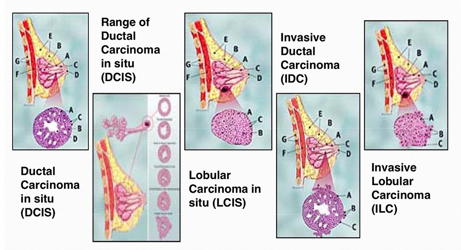 Invasive Ductal Carcinoma Gross